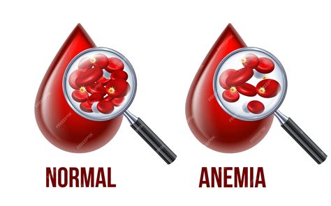 Anemia